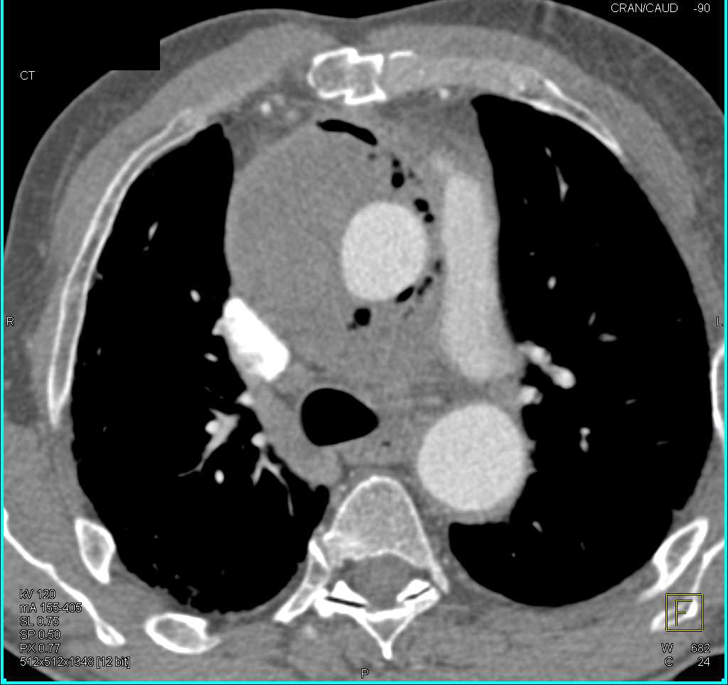 Pseudoaneurysm Aortic Root with Contrast Extravasation - CTisus CT Scan