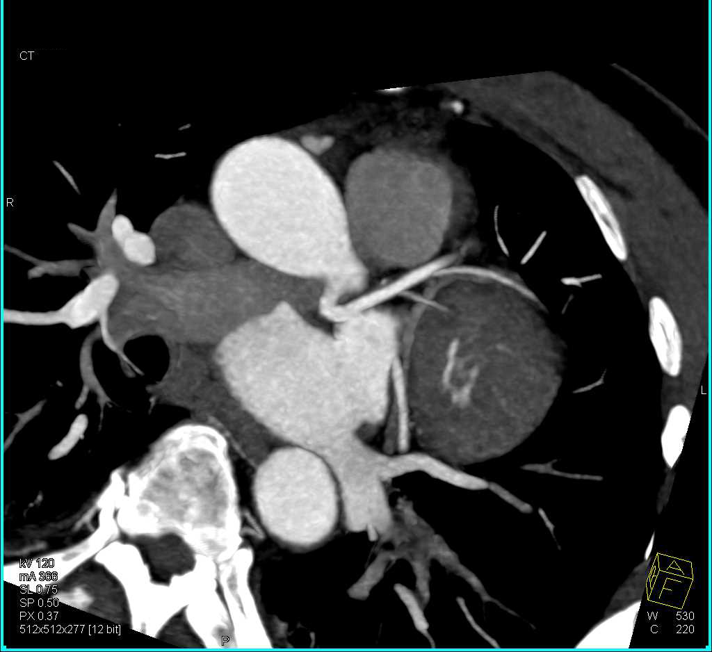 CCTA: Focal Plaque Right Coronary Artery (RCA) Without Stenosis - CTisus CT Scan