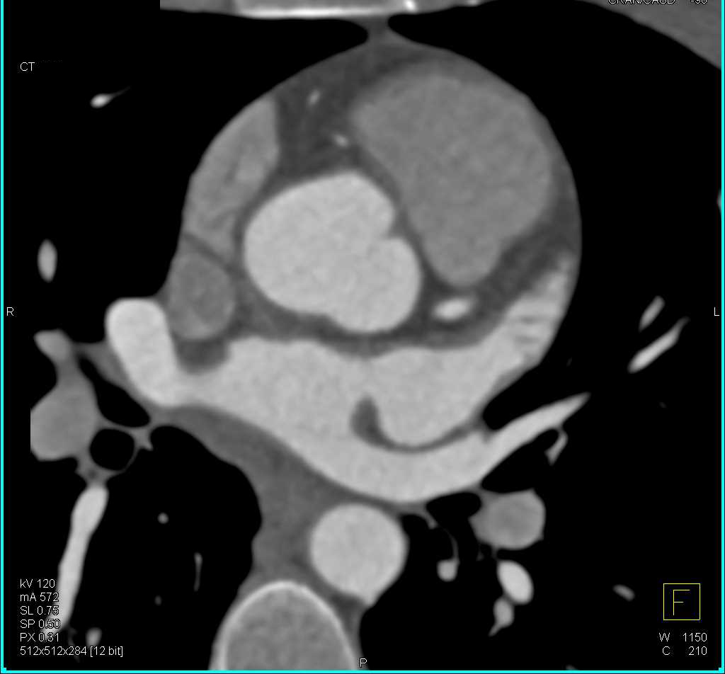 CCTA: Minimal Left Anterior Descending Coronary Artery (LAD) Plaque - CTisus CT Scan