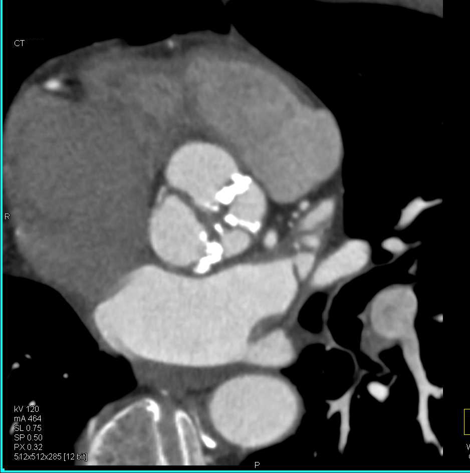 Aortic Stenosis due to Calcified Aortic Valve Leaflets - CTisus CT Scan