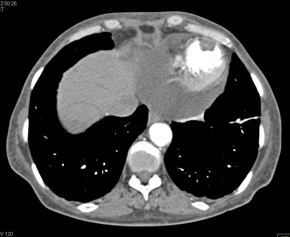 Infarct Left Ventricle with Thrombus - CTisus CT Scan