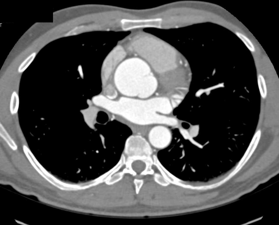 Dilated Aortic Root with Bicuspid Valve - CTisus CT Scan