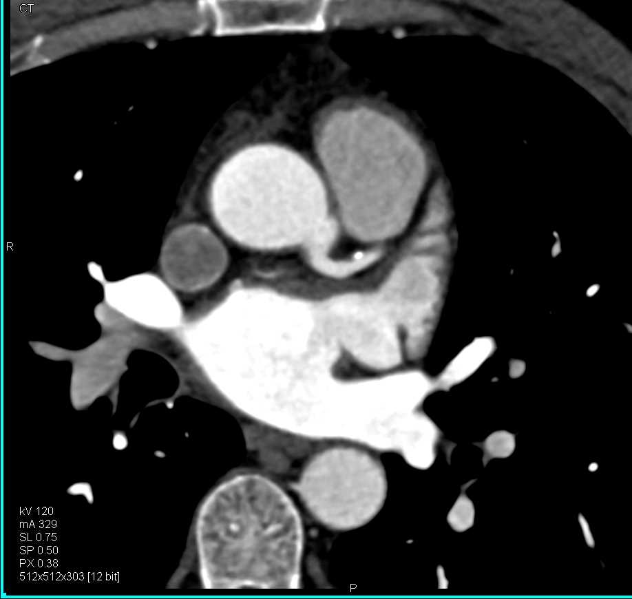 CCTA: Multiple Calcified Left Anterior Descending Coronary Artery (LAD) Plaques - CTisus CT Scan