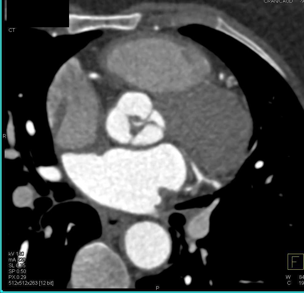 Aortic Valve Thickening - CTisus CT Scan