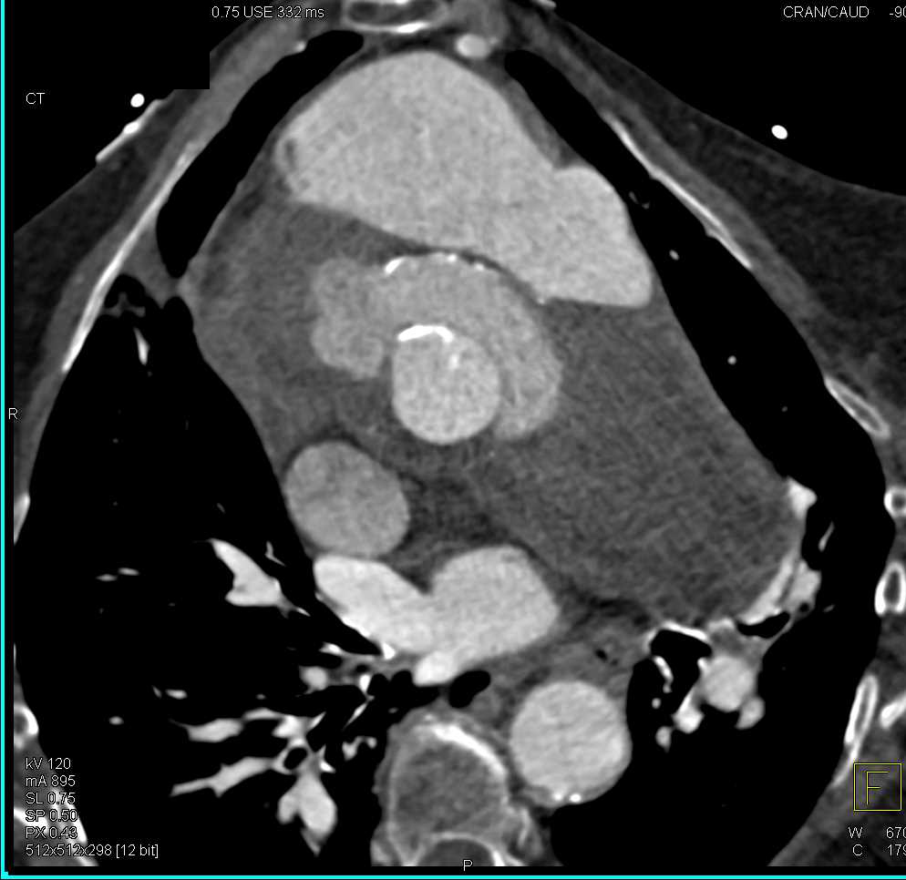 Pseudoaneurysm Aortic Root with Contrast Extravasation - Cardiac Case ...