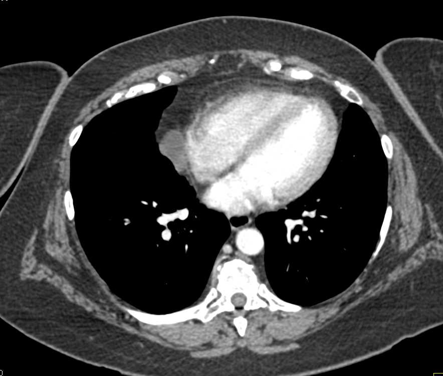 Incidental Pericardial Cyst in Patient Evaluated for Suspected Pancreatic Pathology - CTisus CT Scan