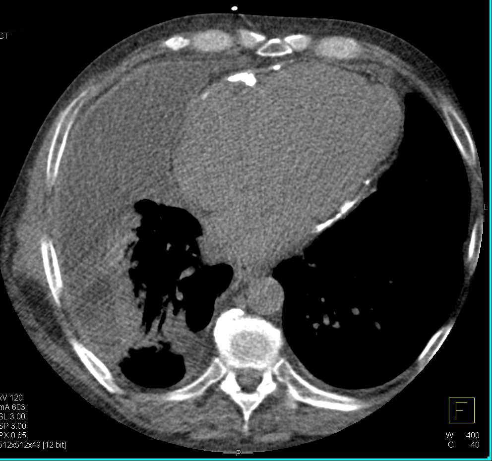 Constrictive Pericarditis with Pericardial Calcification and Inferior Vena Cava (IVC) Reflux - CTisus CT Scan