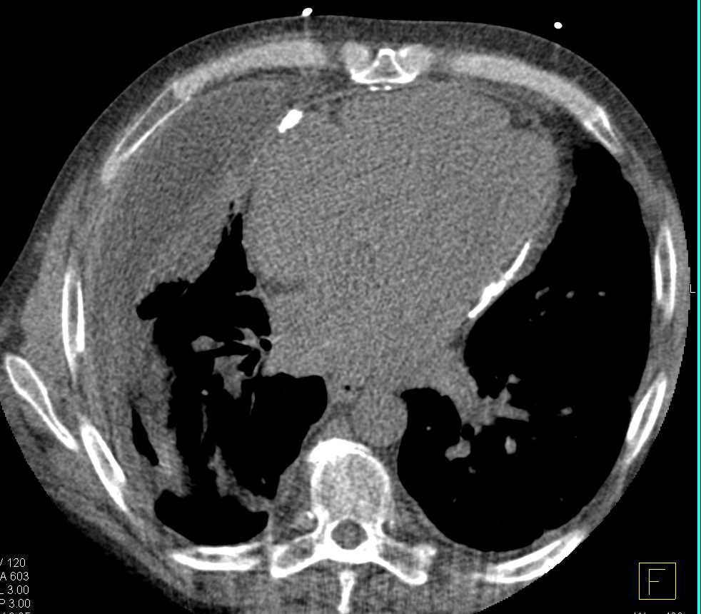 Constrictive Pericarditis with Pericardial Calcification - CTisus CT Scan