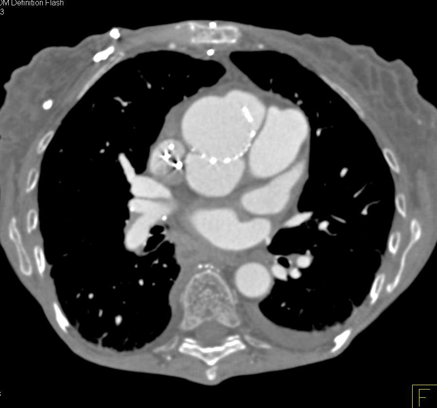 Pseudoaneurysm Aortic Root - CTisus CT Scan