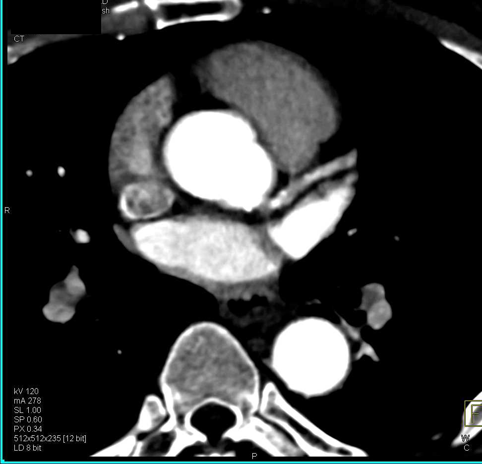 CCTA: High Grade Left Anterior Descending Coronary Artery (LAD) Stenosis - CTisus CT Scan