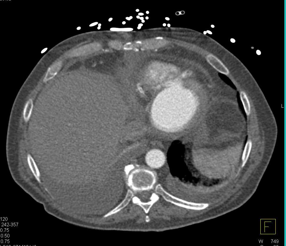 Left Ventricle Aneurysm and Prior Infarct - CTisus CT Scan