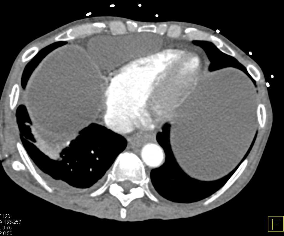 Pericardial Cyst Simulates Ascites - CTisus CT Scan