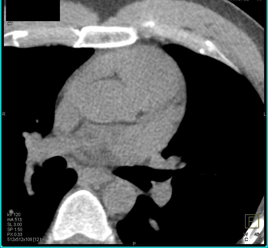 CCTA: Left Anterior Descending Artery (LAD) and Circumflex Artery (CX) arise Directly off the Left Cusp - CTisus CT Scan