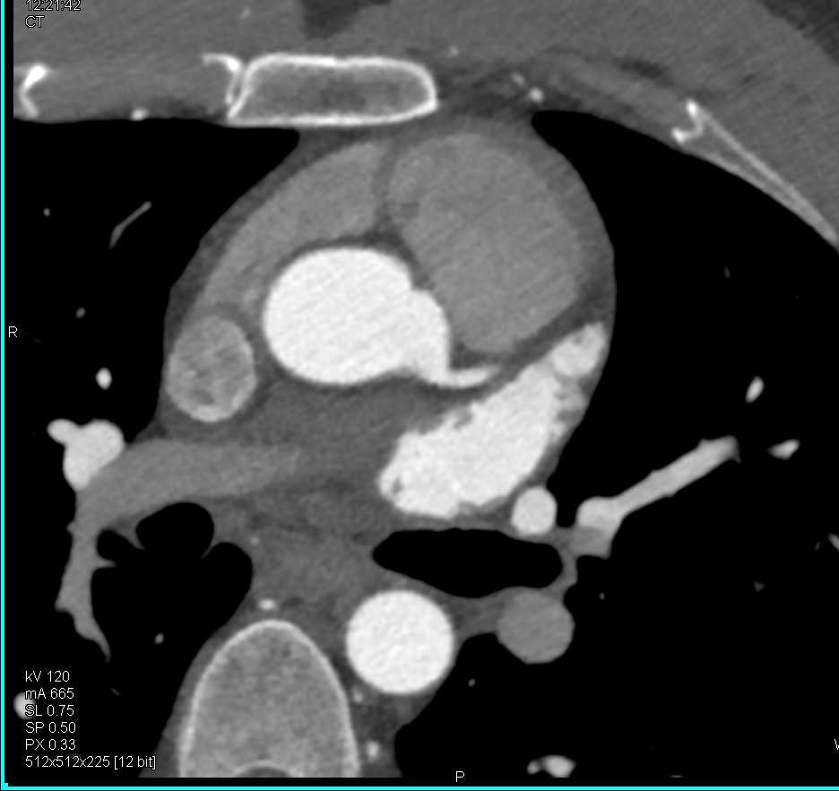 CCTA: Normal Left Atrial Appendage - CTisus CT Scan