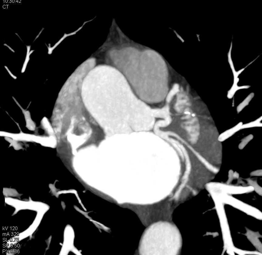 CCTA: Normal Left Anterior Descending Coronary Artery (LAD) in 3D - CTisus CT Scan