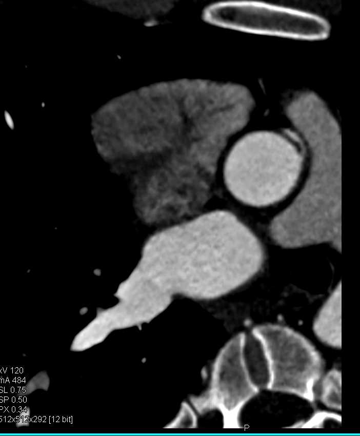 CCTA: Aberrant Origin of Right Coronary Artery (RCA) off Left Cusp - CTisus CT Scan