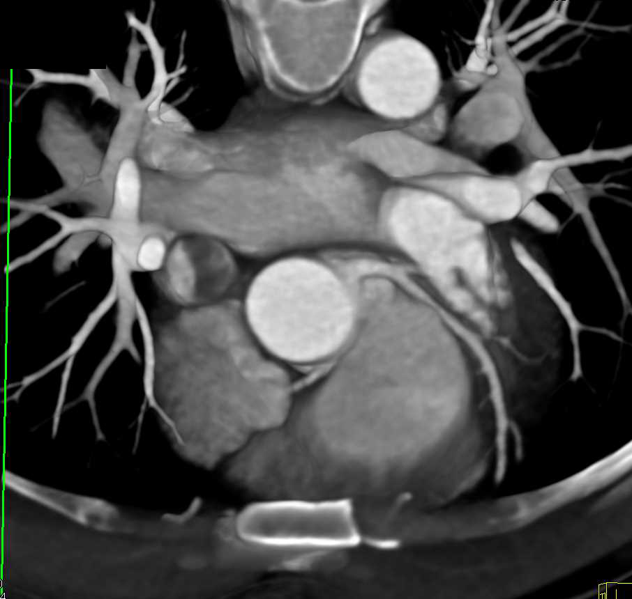 CCTA: Aberrant Origin of Right Coronary Artery (RCA) off Left Cusp - CTisus CT Scan