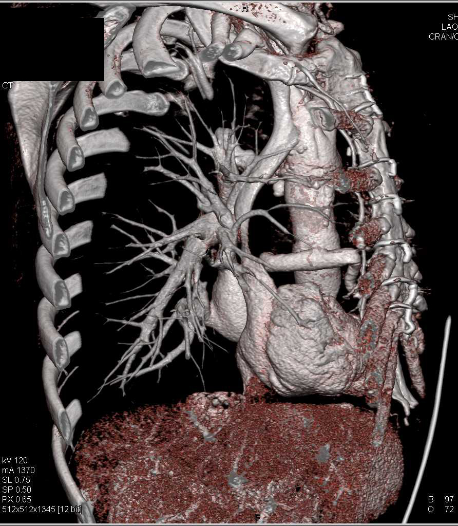 Type A Dissection with Repair Including Reimplanting the Coronary Arteries with a Graft - CTisus CT Scan