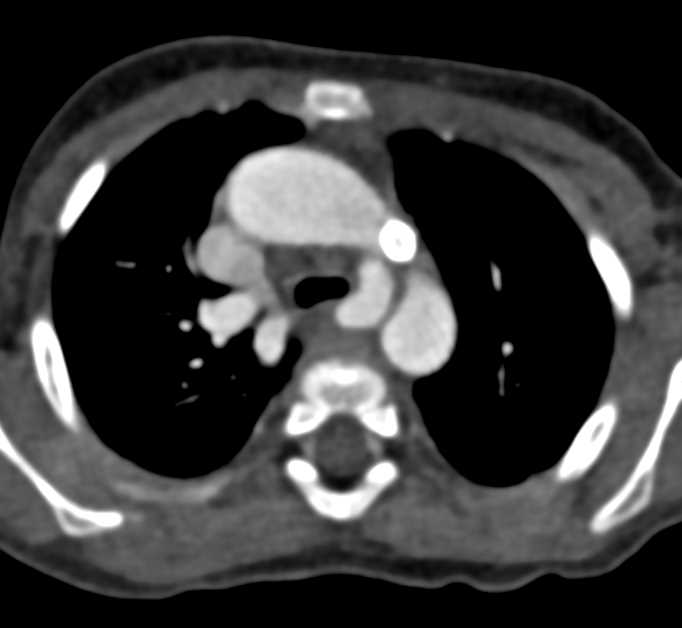 Post Tetralogy of Fallot Repair - CTisus CT Scan