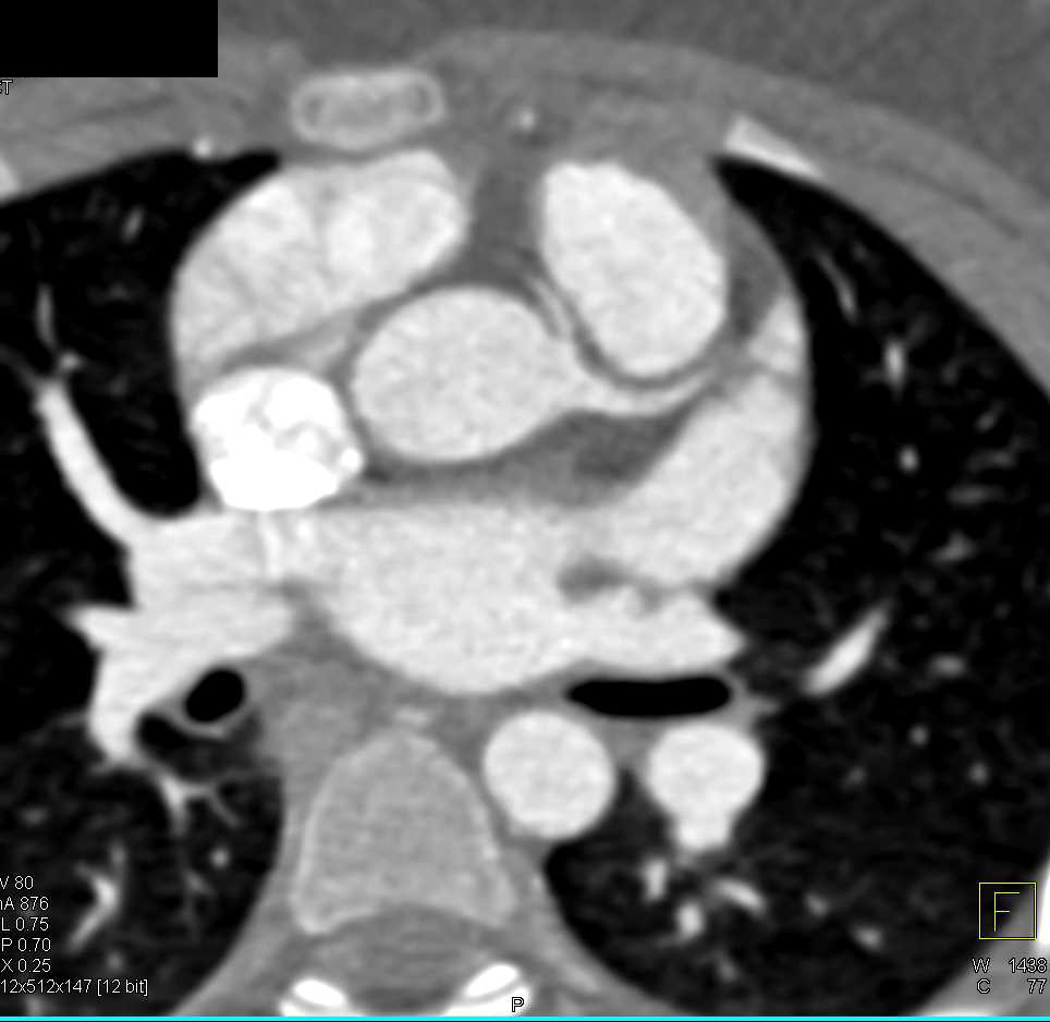 CCTA: Aberrant Origin of Right Coronary Artery (RCA) off Left Cusp - CTisus CT Scan
