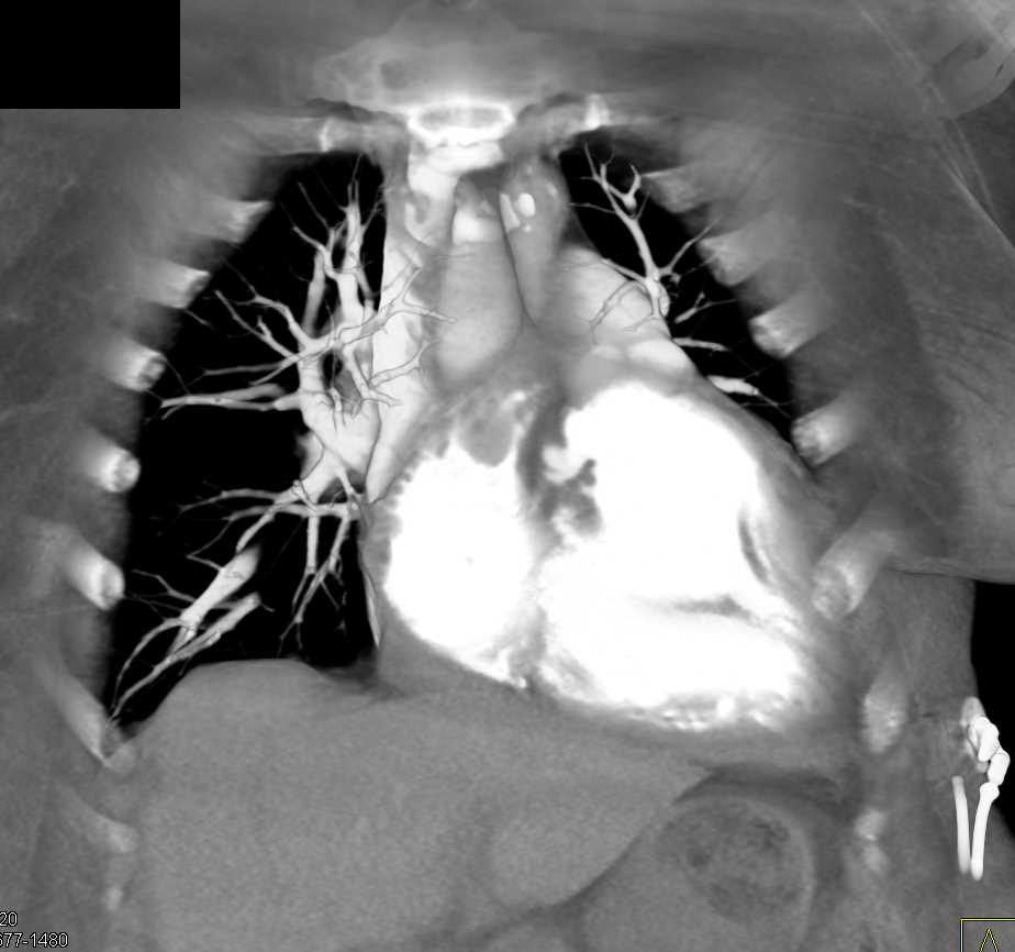 Thrombus in the Right Ventricle - CTisus CT Scan