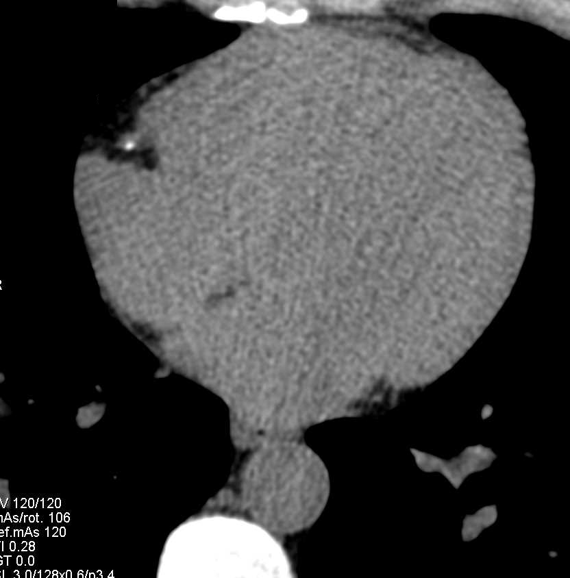 Calcium Detected in the Right Coronary Artery - CTisus CT Scan