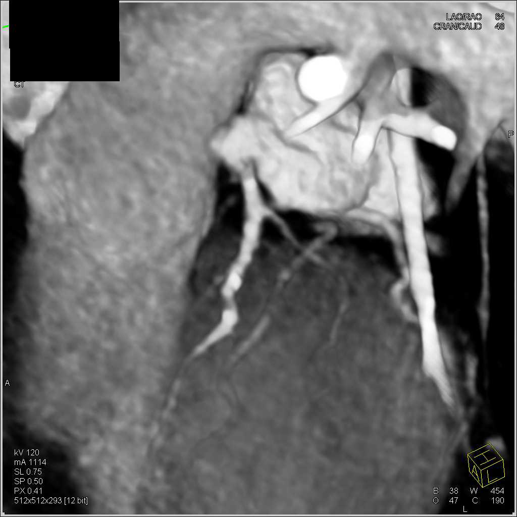 CCTA: High Grade Left Anterior Descending Coronary Artery (LAD) Stenosis - CTisus CT Scan