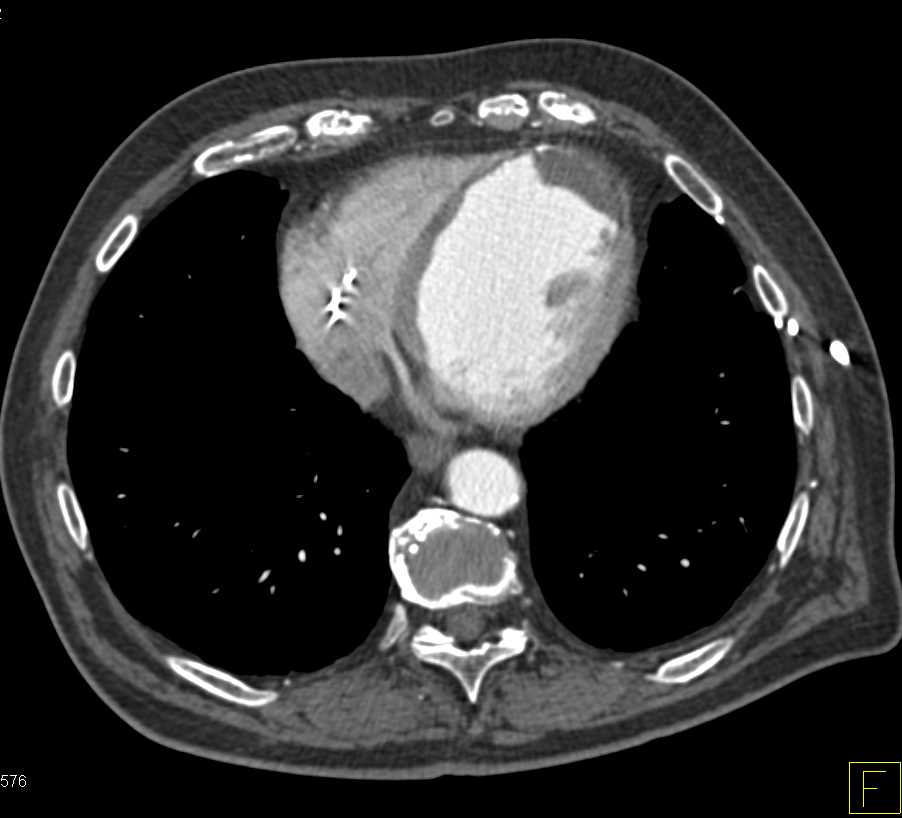 Infarct Left Ventricular Wall - CTisus CT Scan