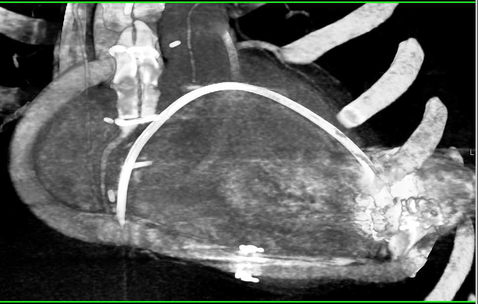 Graft from Aorta to Left Ventricle - CTisus CT Scan