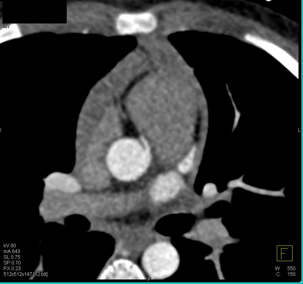 CCTA: Aberrant Origin of Right Coronary Artery (RCA) off Left Cusp - CTisus CT Scan