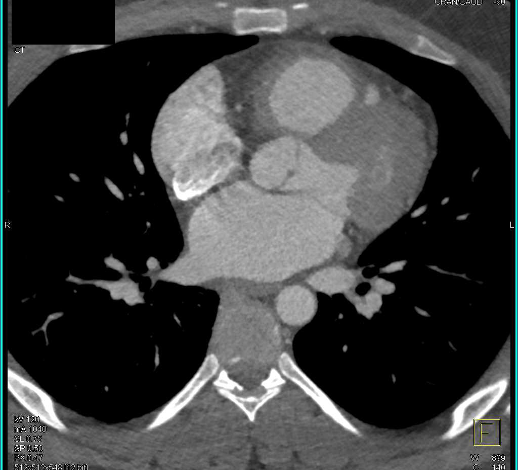 Bicuspid Valve in Patient with a History of Coarctation of the Aorta - CTisus CT Scan