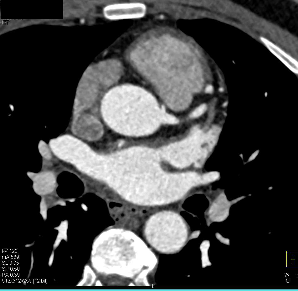 CCTA: Aberrant Origin of Right Coronary Artery (RCA) off Left Cusp - CTisus CT Scan