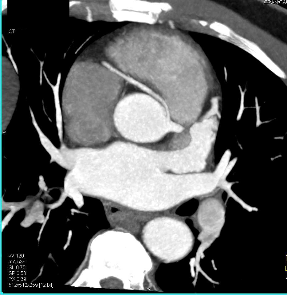 CCTA: Aberrant Origin of Right Coronary Artery (RCA) off Left Cusp - CTisus CT Scan