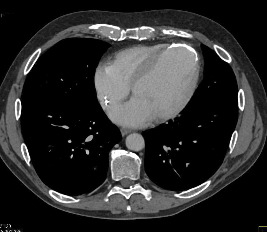 Old Left Ventricular Infarct - CTisus CT Scan