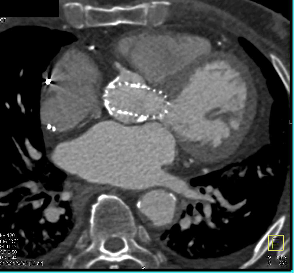 CTA in Patient with Prior Transcatheter Aortic Valve Replacement (TAVR) Repair of Aortic Valve - CTisus CT Scan