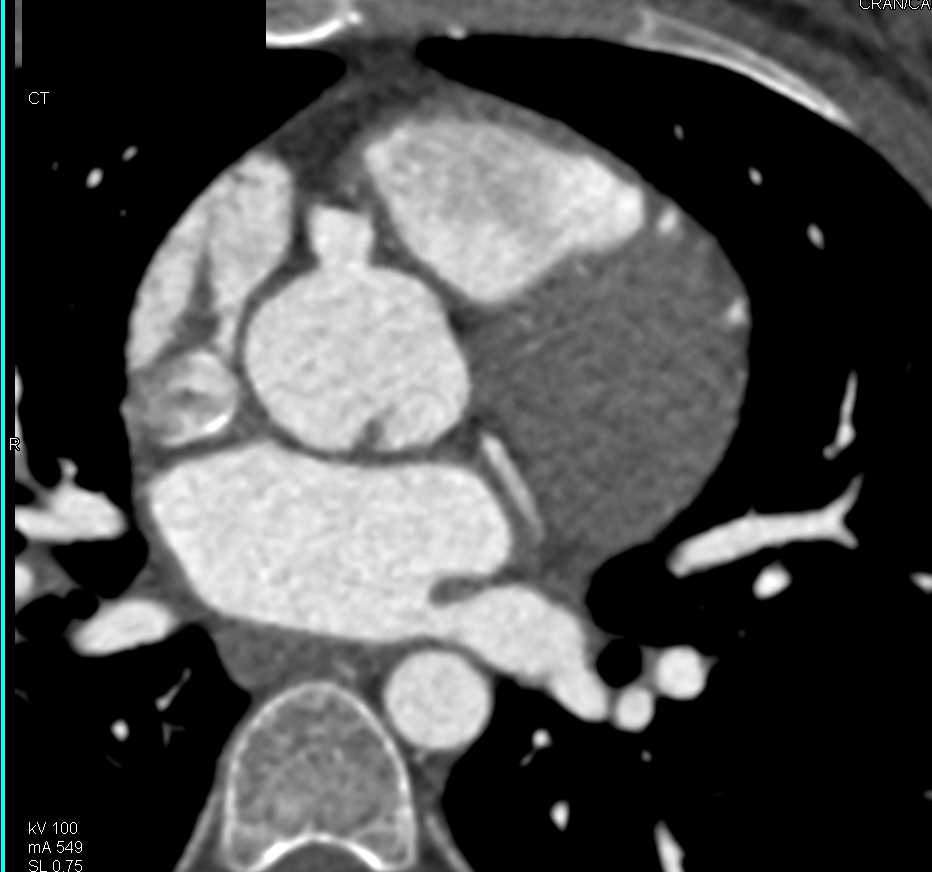 CCTA: Aneurysm of the Right Coronary Artery - CTisus CT Scan