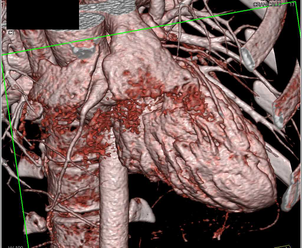 CCTA: Aneurysm of the Right Coronary Artery - CTisus CT Scan