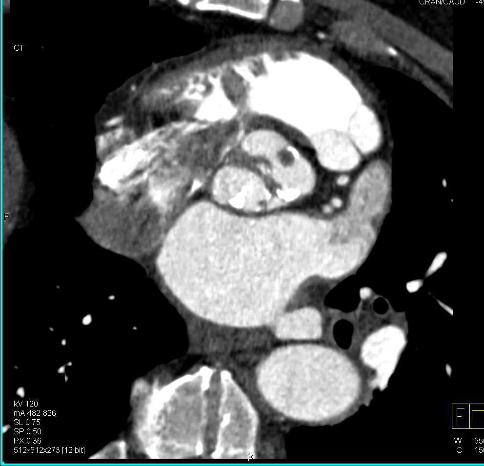 Thrombus on Aortic Valve - CTisus CT Scan