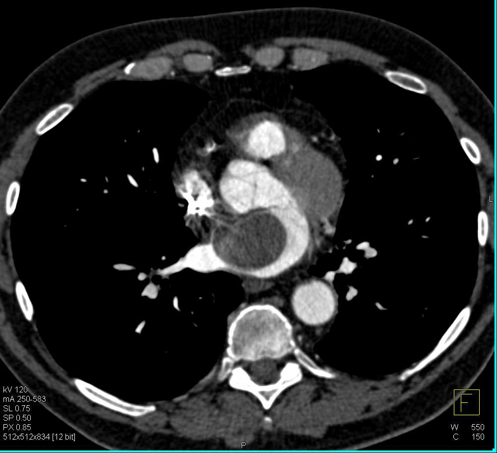 Left Atrial Myxoma - CTisus CT Scan