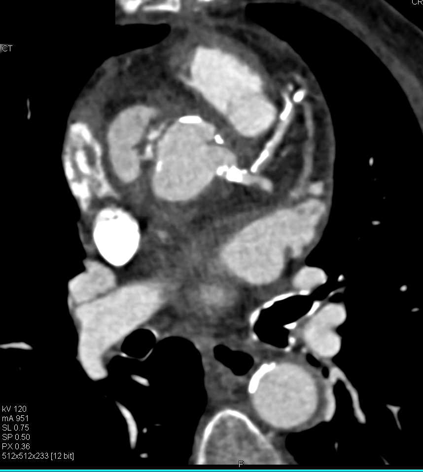 Pseudoaneurysm Aortic Root - CTisus CT Scan