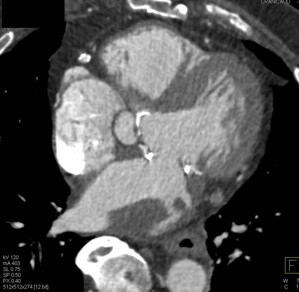 Large Thrombus in the Left Atrium - Cardiac Case Studies - CTisus CT ...