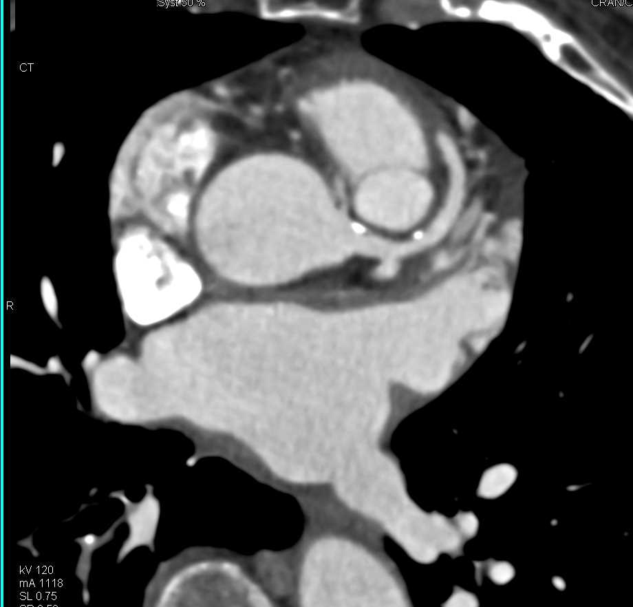 CCTA: Right Coronary Artery Arises off the Left Cusp - CTisus CT Scan