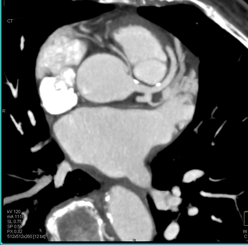 CCTA: Right Coronary Artery Arises off the Left Cusp and Pulmonary Embolism - CTisus CT Scan