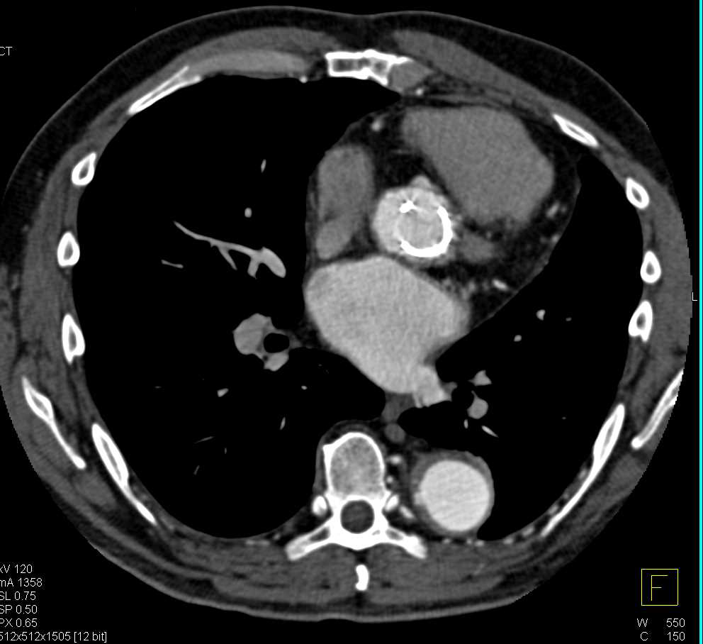 Thoracic Aorta Aneurysm Repair with Aortic Valve Replacement (AVR) - CTisus CT Scan