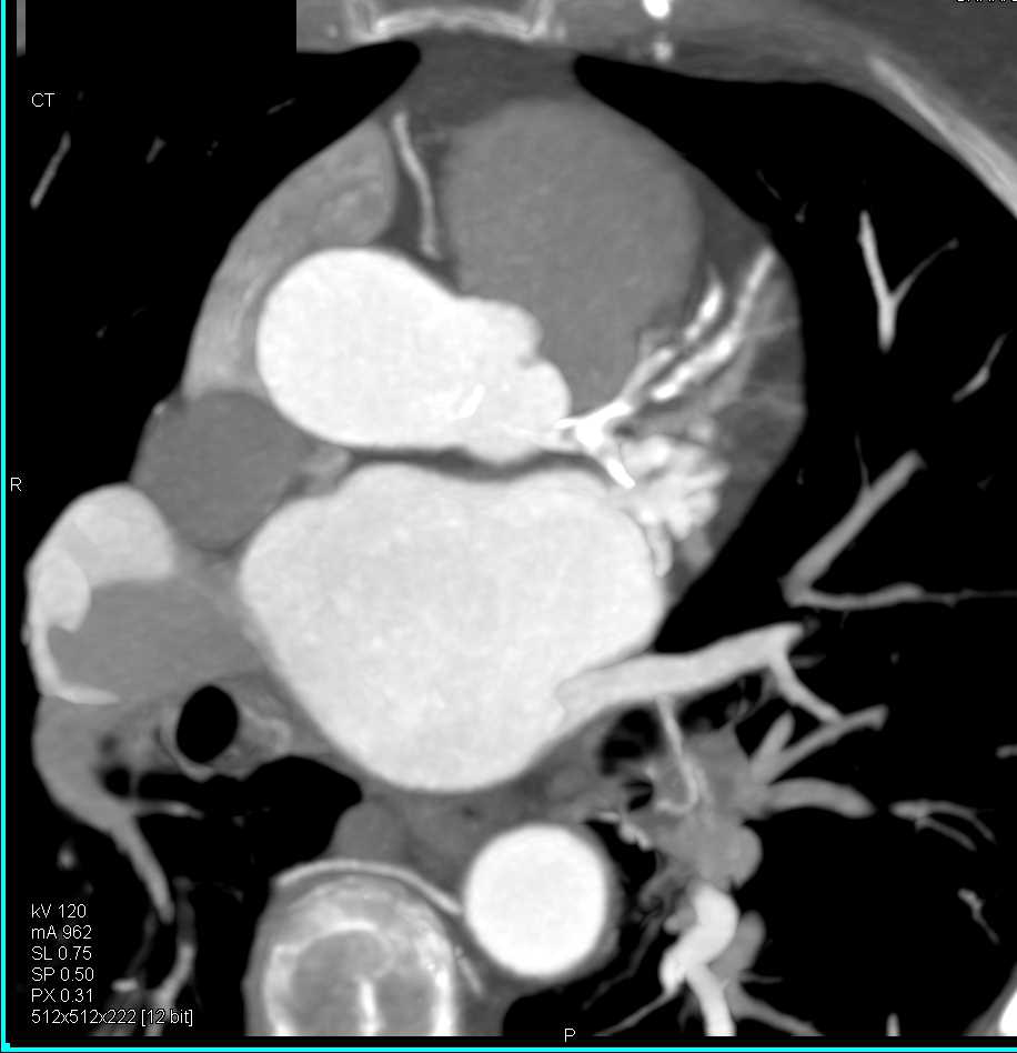 CCTA: Critical Stenosis in the Left Anterior Descending Coronary Artery (LAD) - CTisus CT Scan