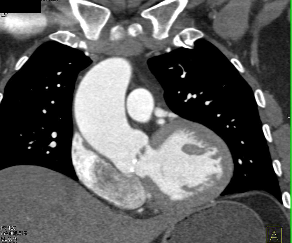 Pseudo thrombus in the Right Atrium - CTisus CT Scan