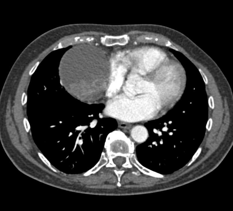 Fluid-Fluid Level in a Pericardial Cyst - CTisus CT Scan