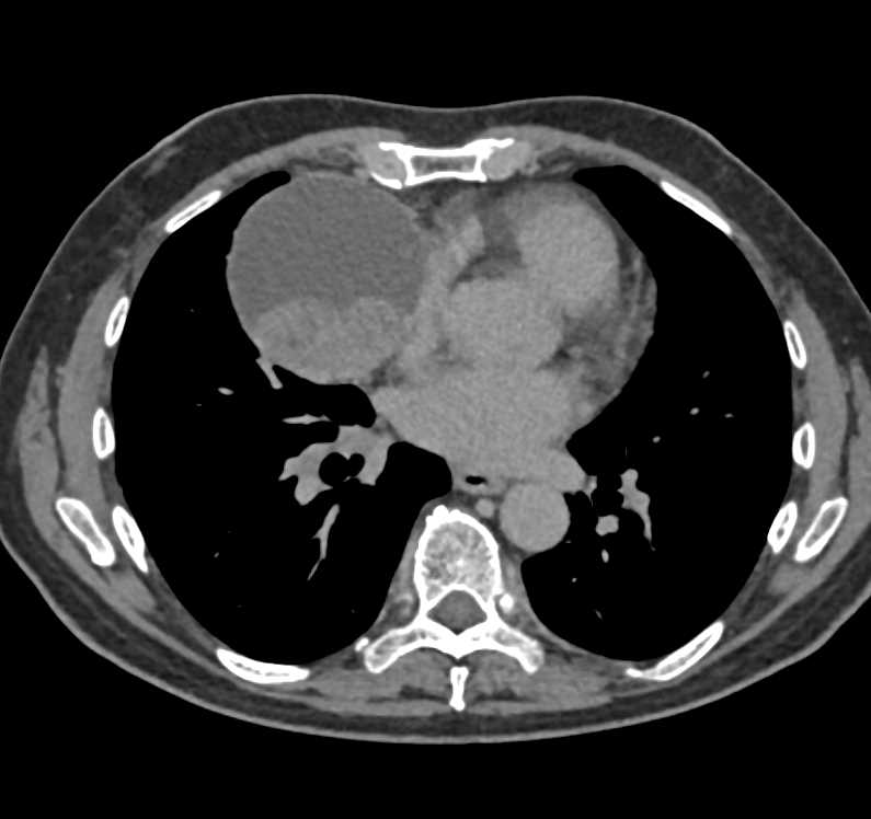 Fluid-Fluid Level in a Pericardial Cyst - CTisus CT Scan