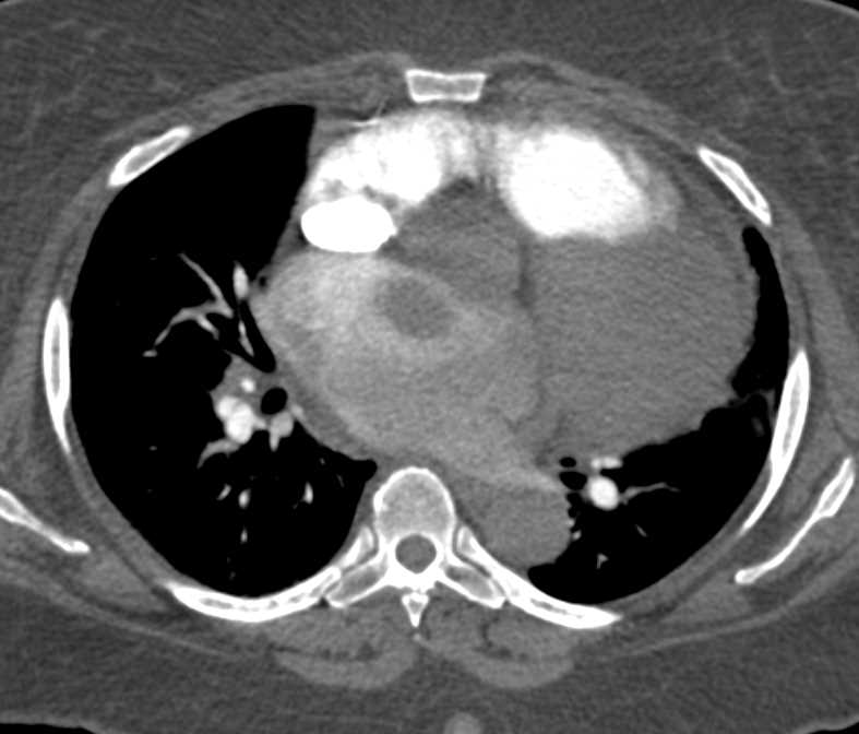 Left Atrial Thrombus - CTisus CT Scan