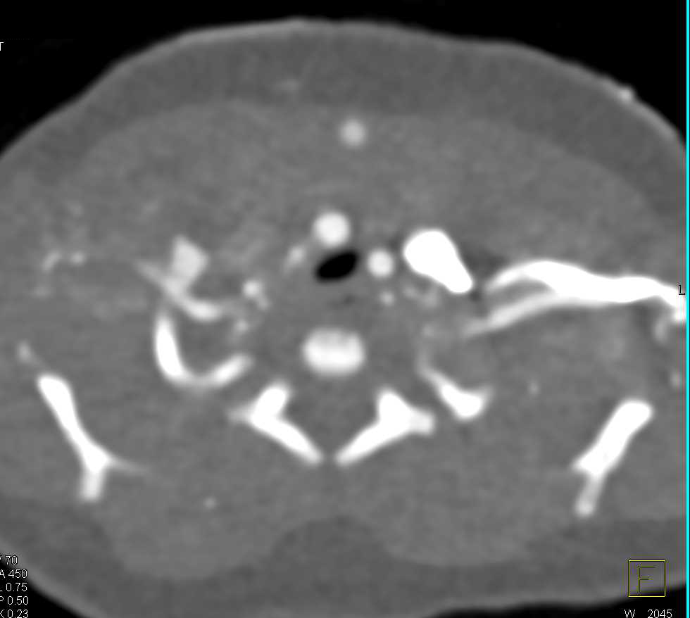 Prominent Bronchial Artery in Patient with Congenital Heart Disease - CTisus CT Scan